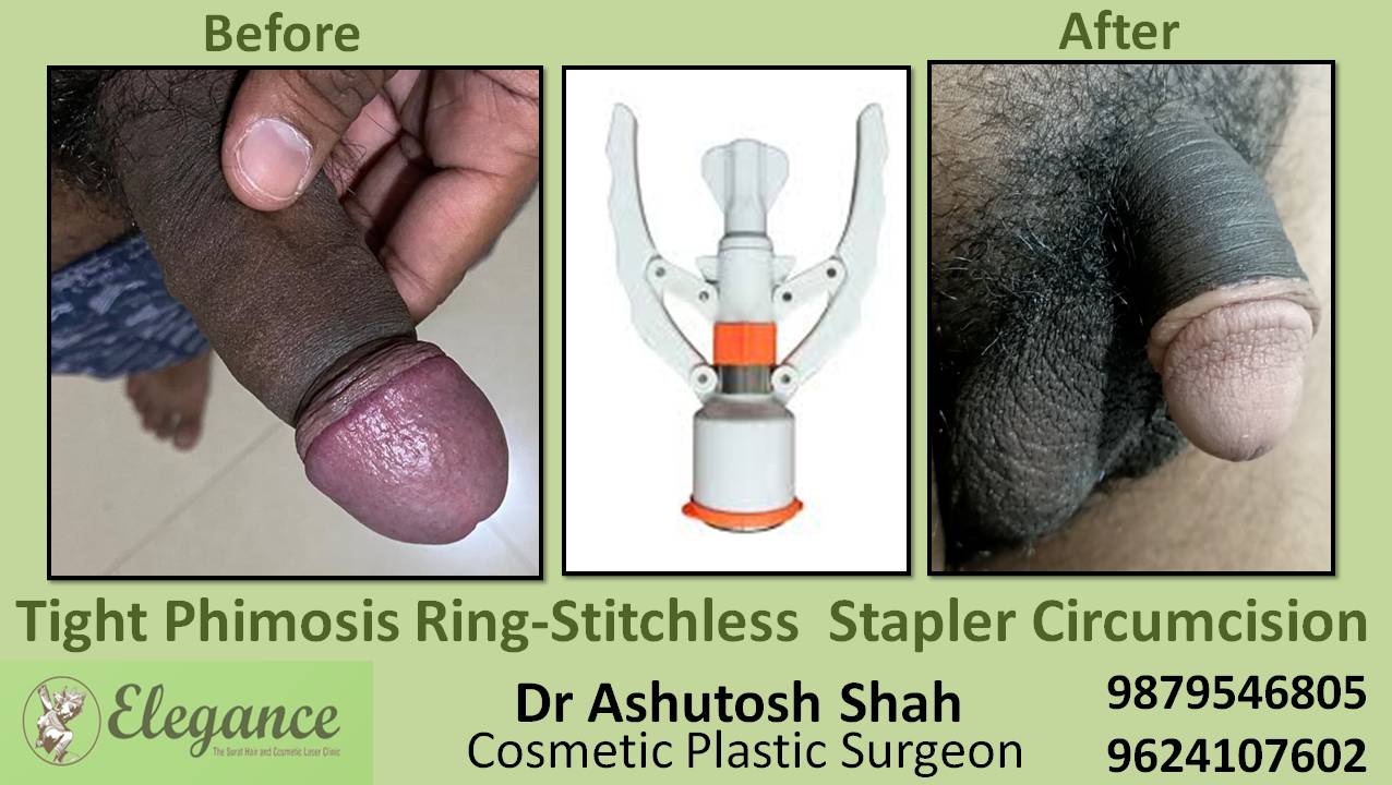 Total Phimosis-Stitchless Stapler Circumcision in Bardoli, Gujarat
