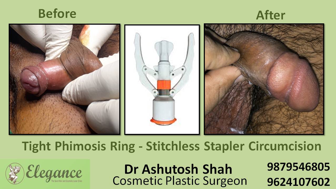 Total Phimosis-Stitchless Stapler Circumcision in Baroda, Gujarat