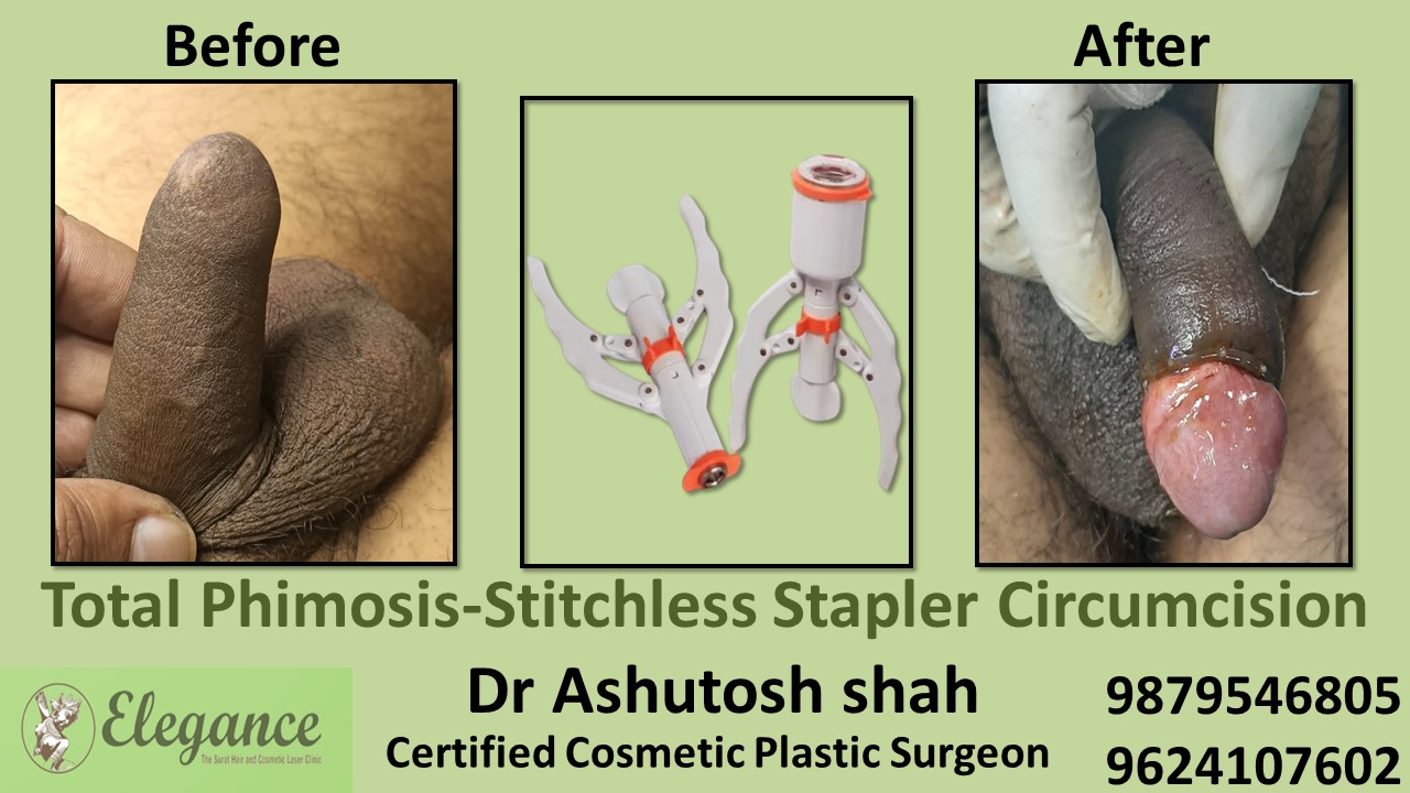 Total Phimosis-Stitchless Stapler Circumcision in Surat