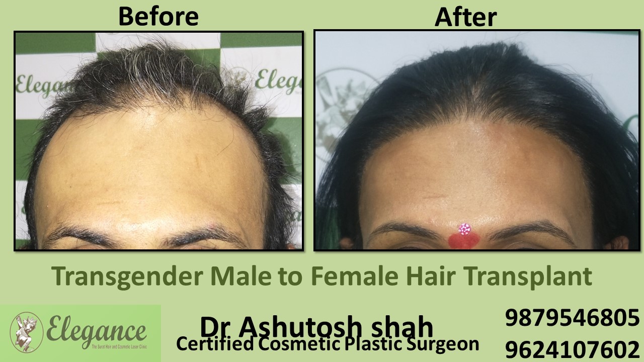 Transgender Hair Transplant in Ankleshwar, Gujarat, India.