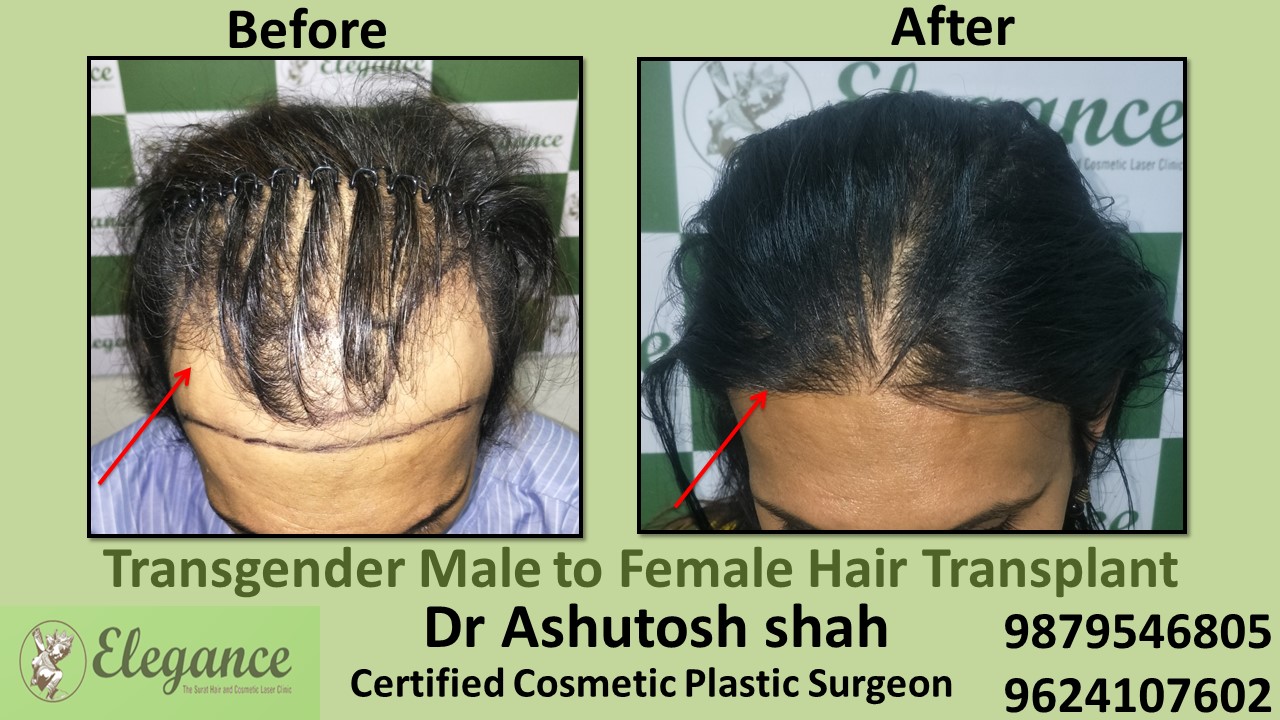 Transgender Hair Transplant in Bardoli, Gujarat, India.