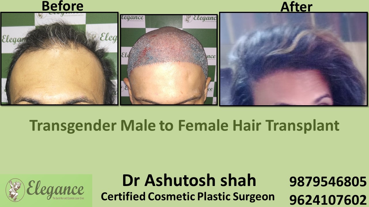 Transgender Hair Transplant in Kosamba, Gujarat, India.