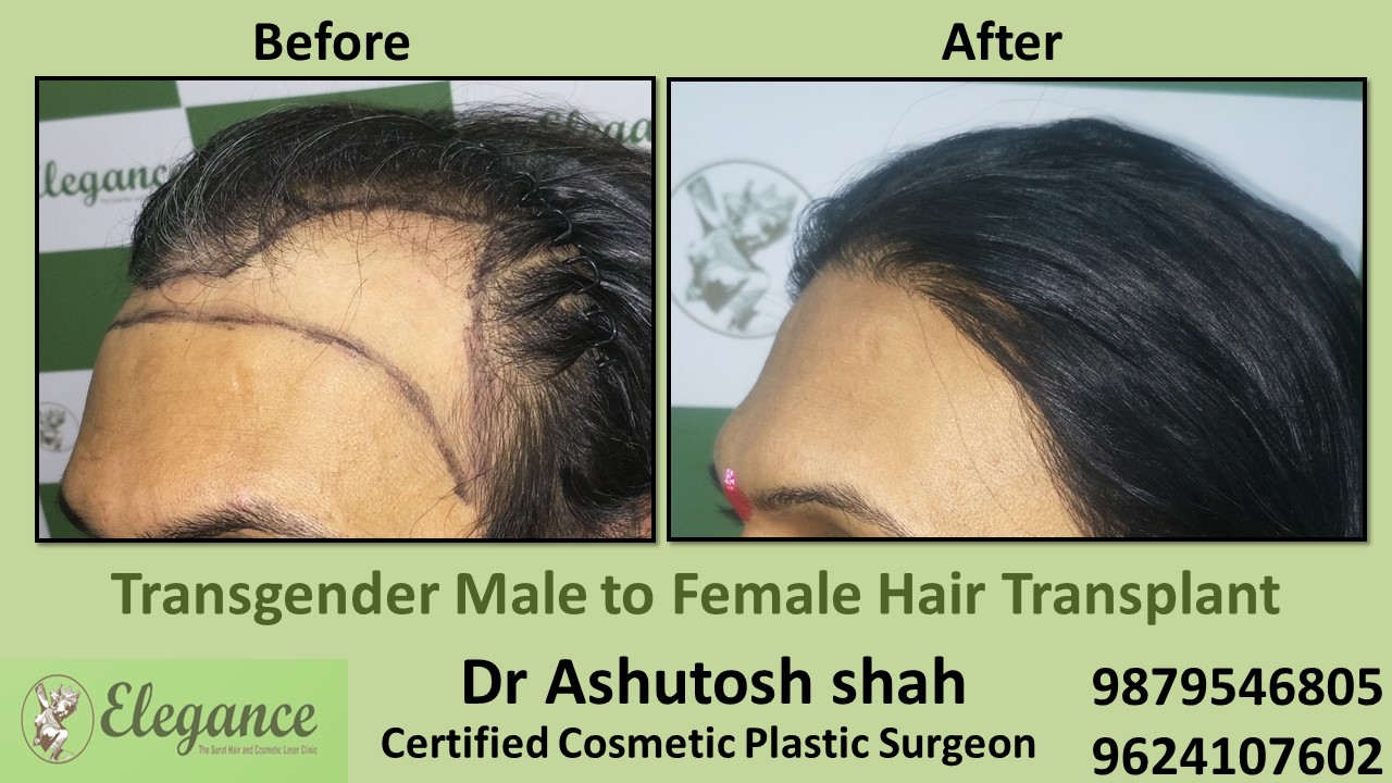 Transgender Hair Transplant in Navsari, Gujarat, India.