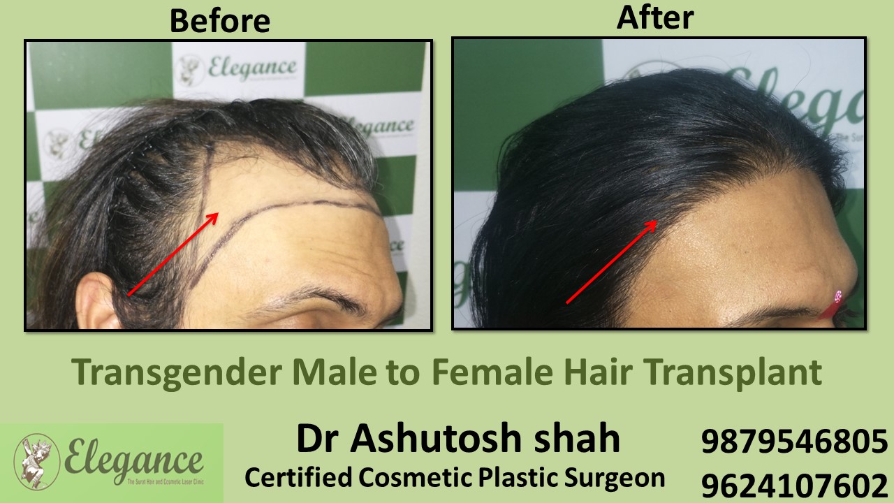 Transgender Hair Transplant in Surat, Gujarat, India.