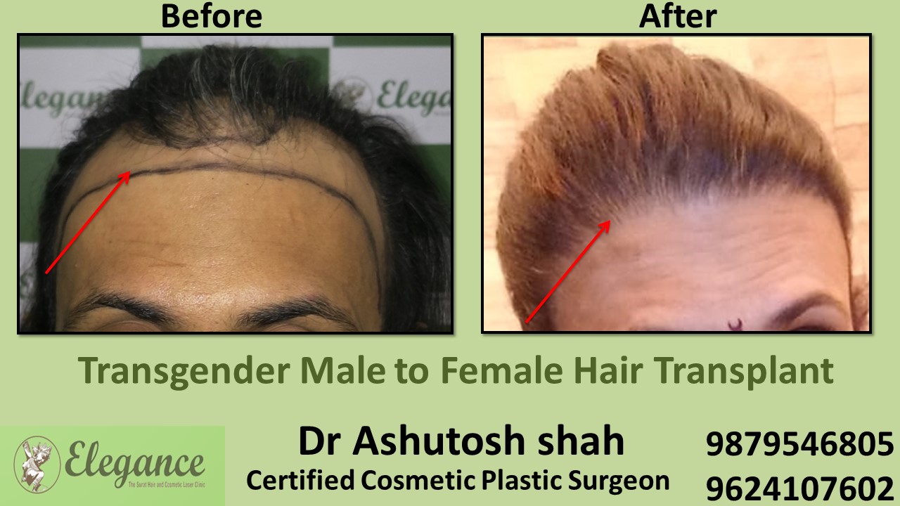 Transgender Hair Transplant in Valsad, Gujarat, India.