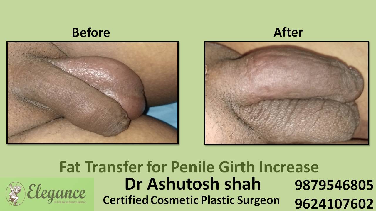 Penile Girth Increase (Fat Grafting) in Surat (Gujarat) India