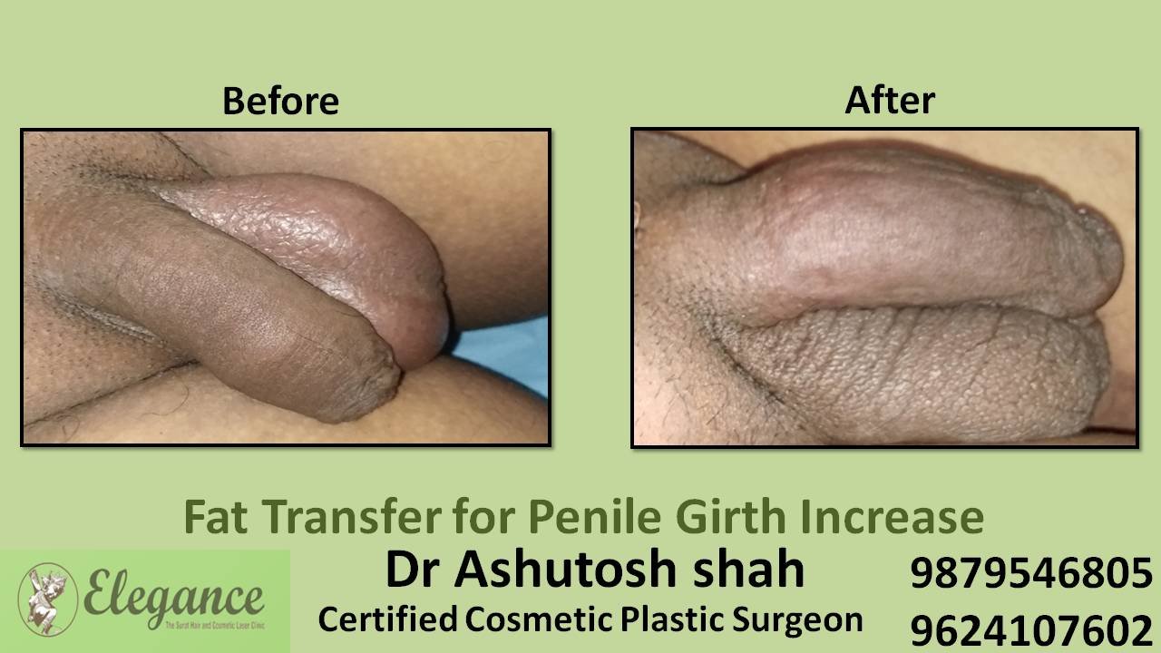 Treatment for Fat Transfer from Peniel Girth in Surat, Gujarat