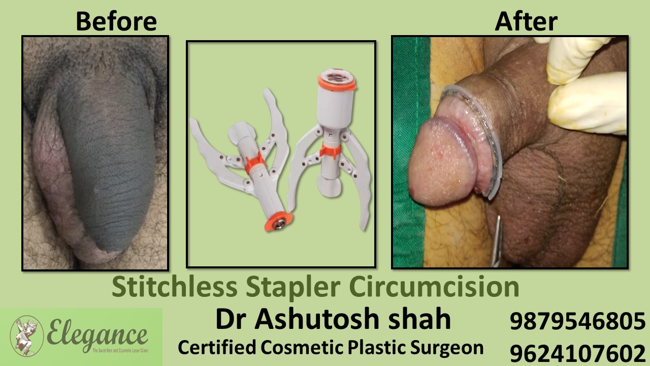 Treatment for Stitchless Stapler Circumcision in Surat