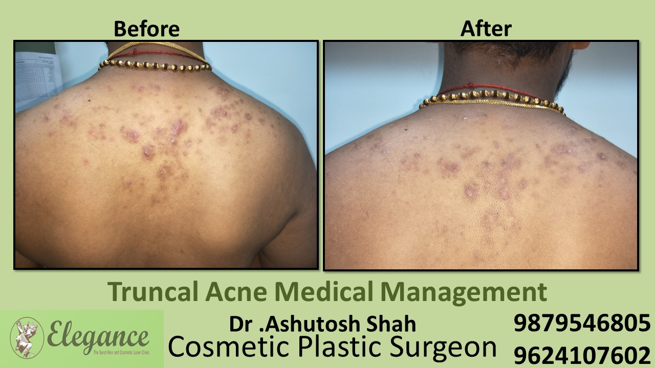 Truncal Acne Medical Management, Bharuch, Gujarat, India.