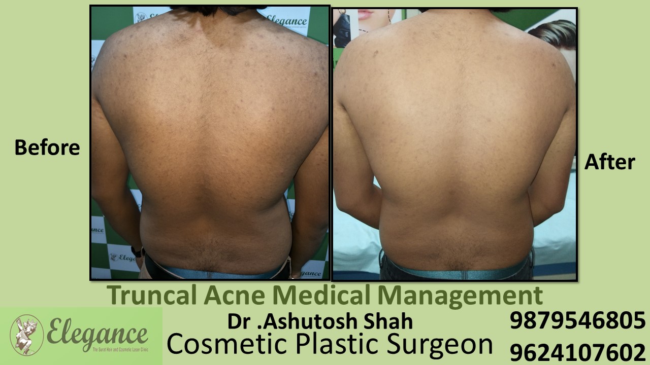 Truncal Acne Medical Management, Navsari, Gujarat, India.