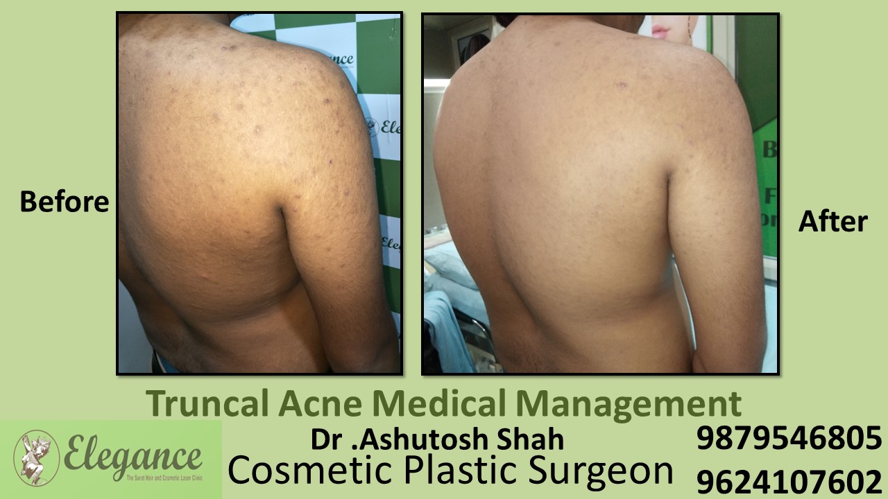 Truncal Acne Medical Management, Surat, Gujarat, India.