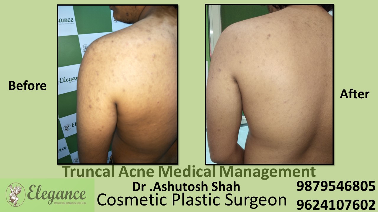 Truncal Acne Medical Management, Valsad, Gujarat, India.