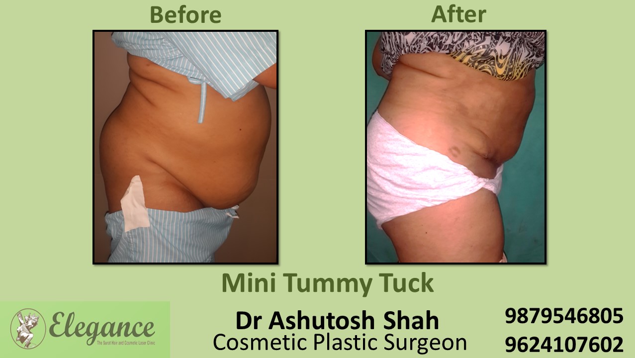 Tummy Tuck Surgery, Bharuch, Gujarat, India