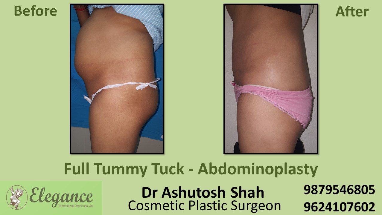 Tummy Tuck Surgery, Daman, Gujarat, India.