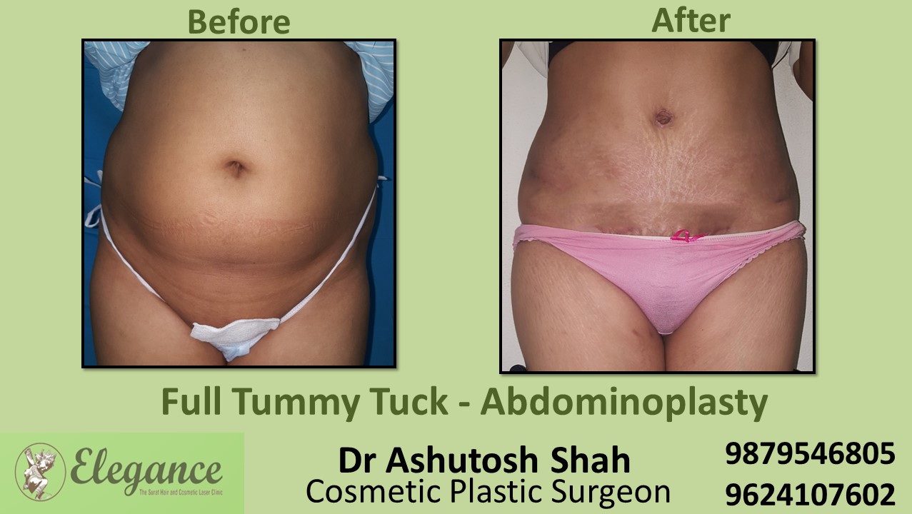 Tummy Tuck Surgery, Surat, Gujarat, India.