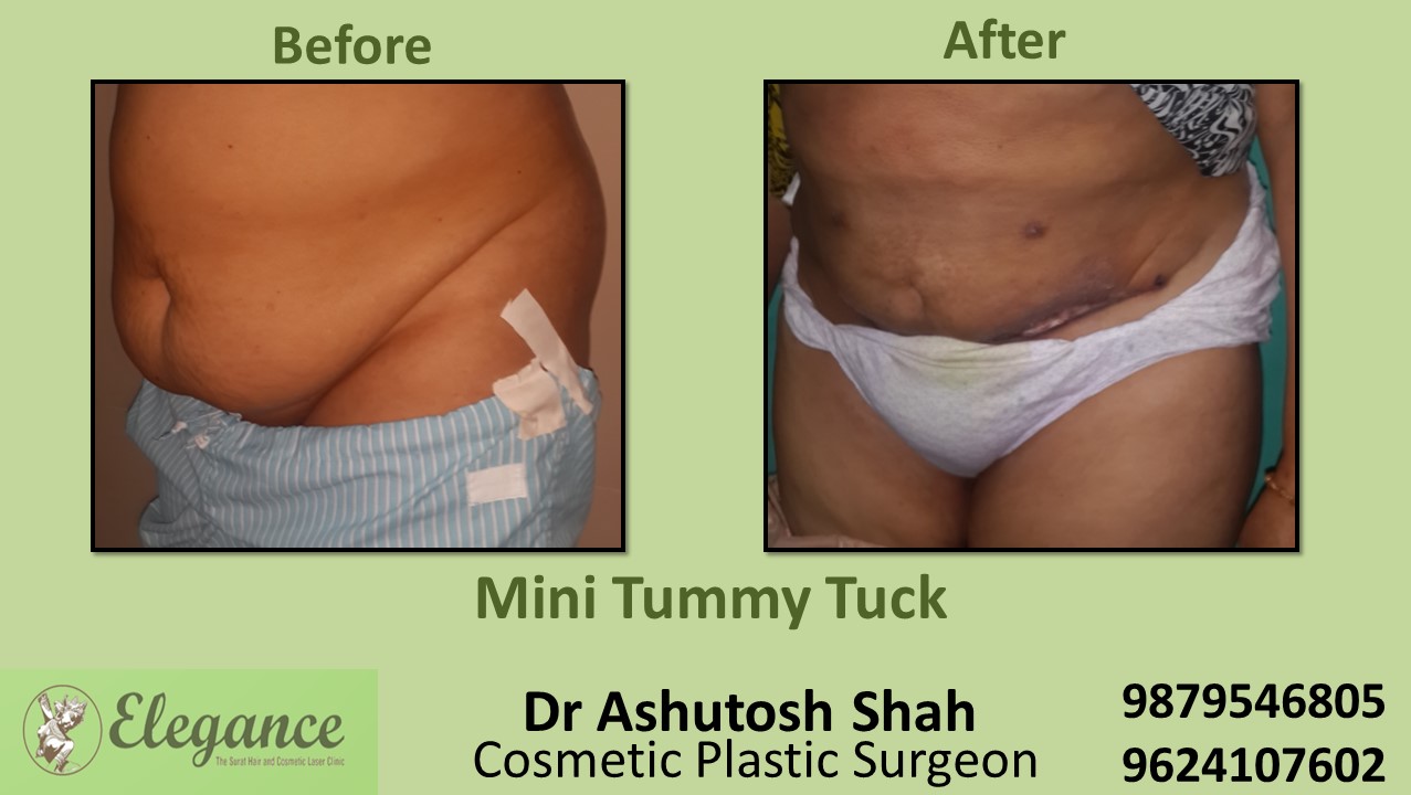 Tummy Tuck Surgery, Vadodara, Gujarat, India.