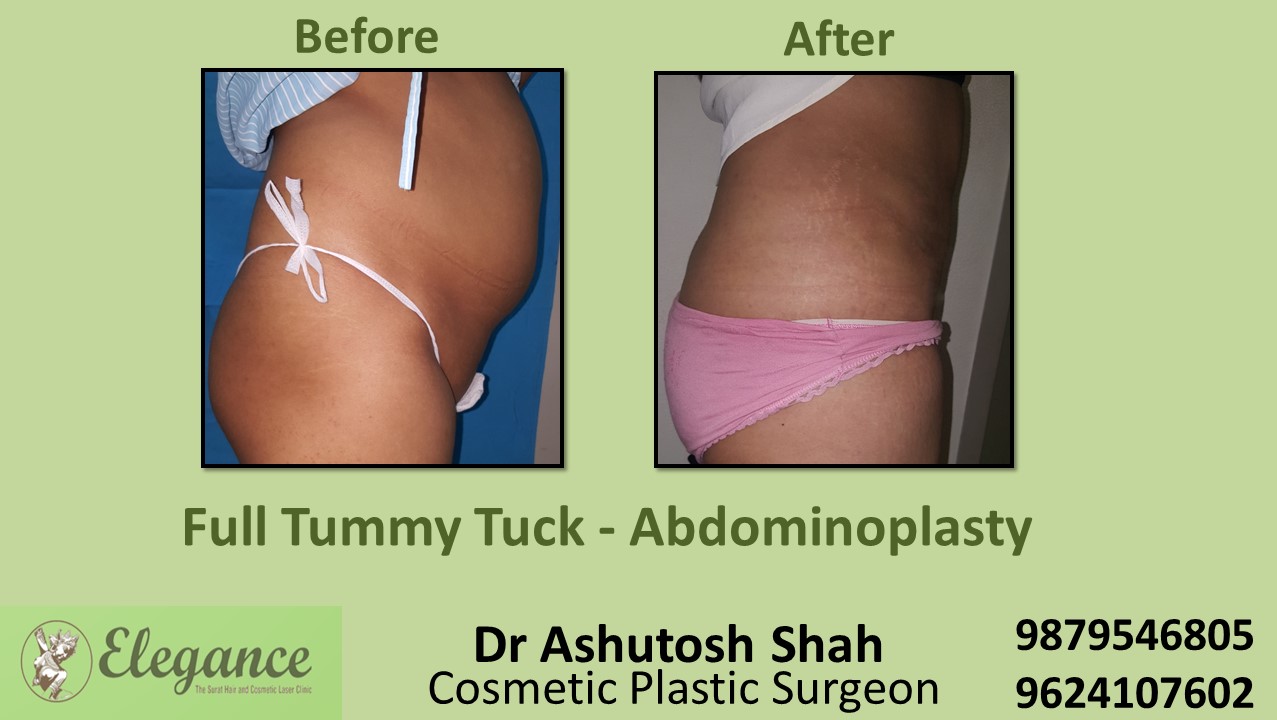 Tummy Tuck Surgery, Vapi, Gujarat, India.