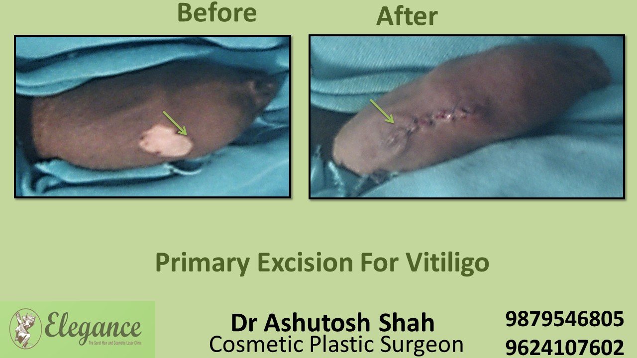 Vitiligo penis