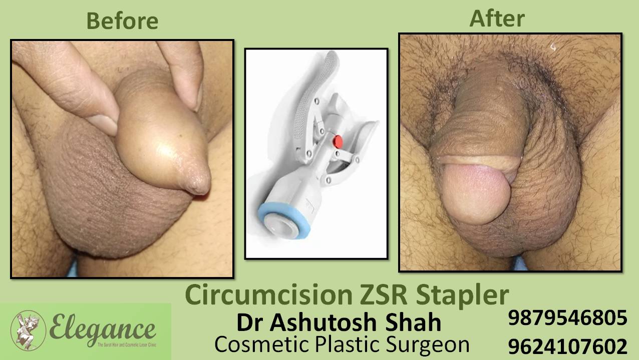 ZSR Circumcision Surgery, Bardoli, Gujarat, India
