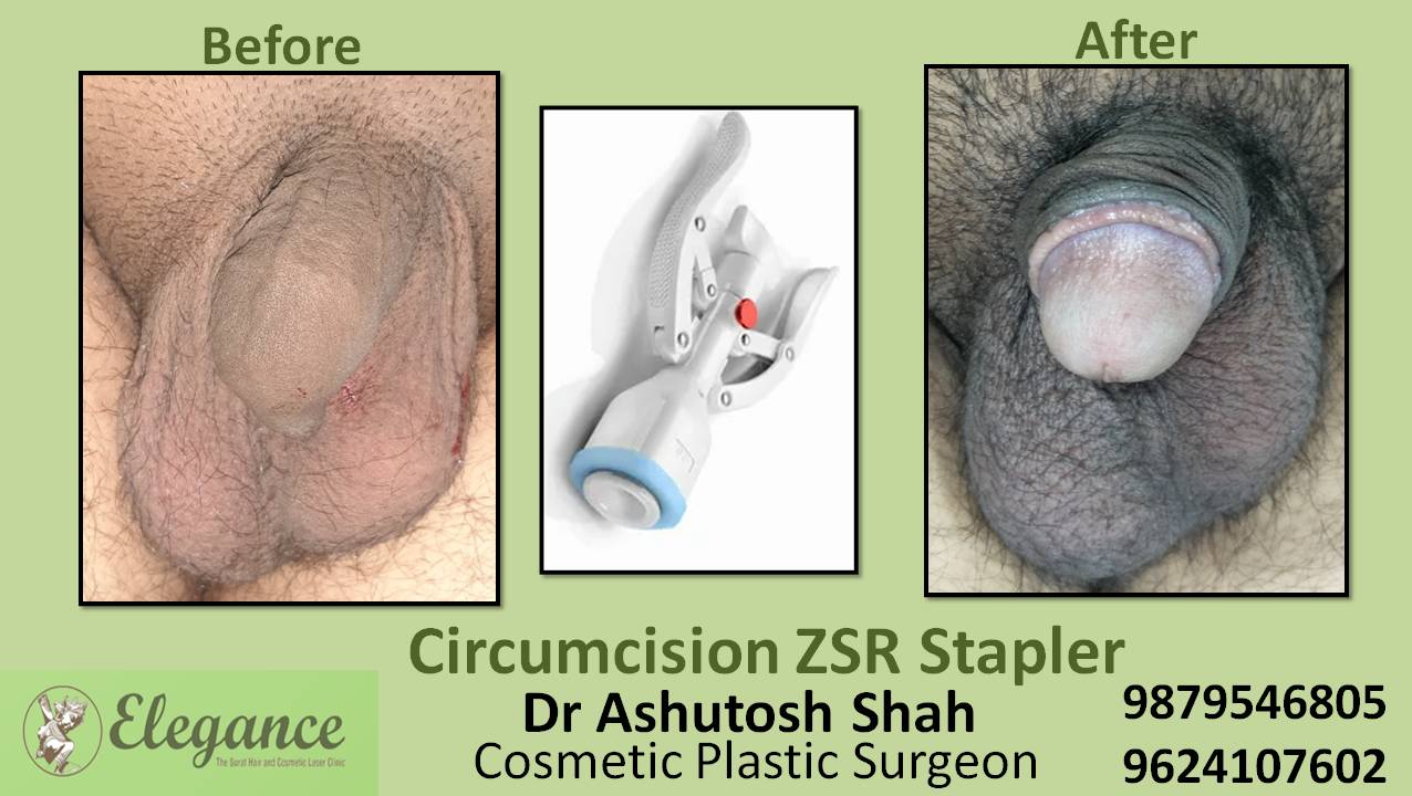 ZSR Circumcision Surgery, Navsari, Gujarat, India