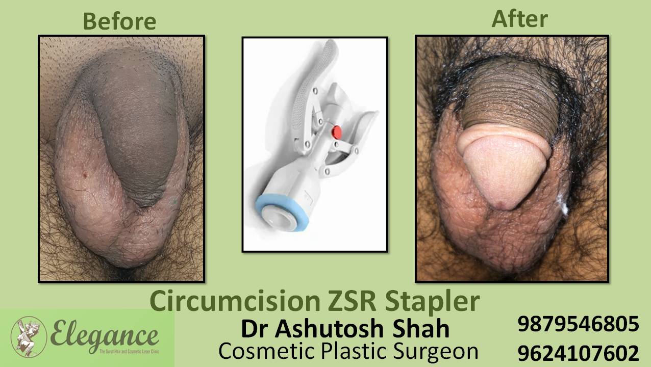 ZSR Circumcision Surgery, Surat, Gujarat, India