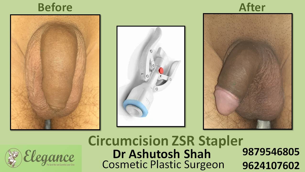 ZSR Circumcision Surgery, Vadodara, Gujarat, India