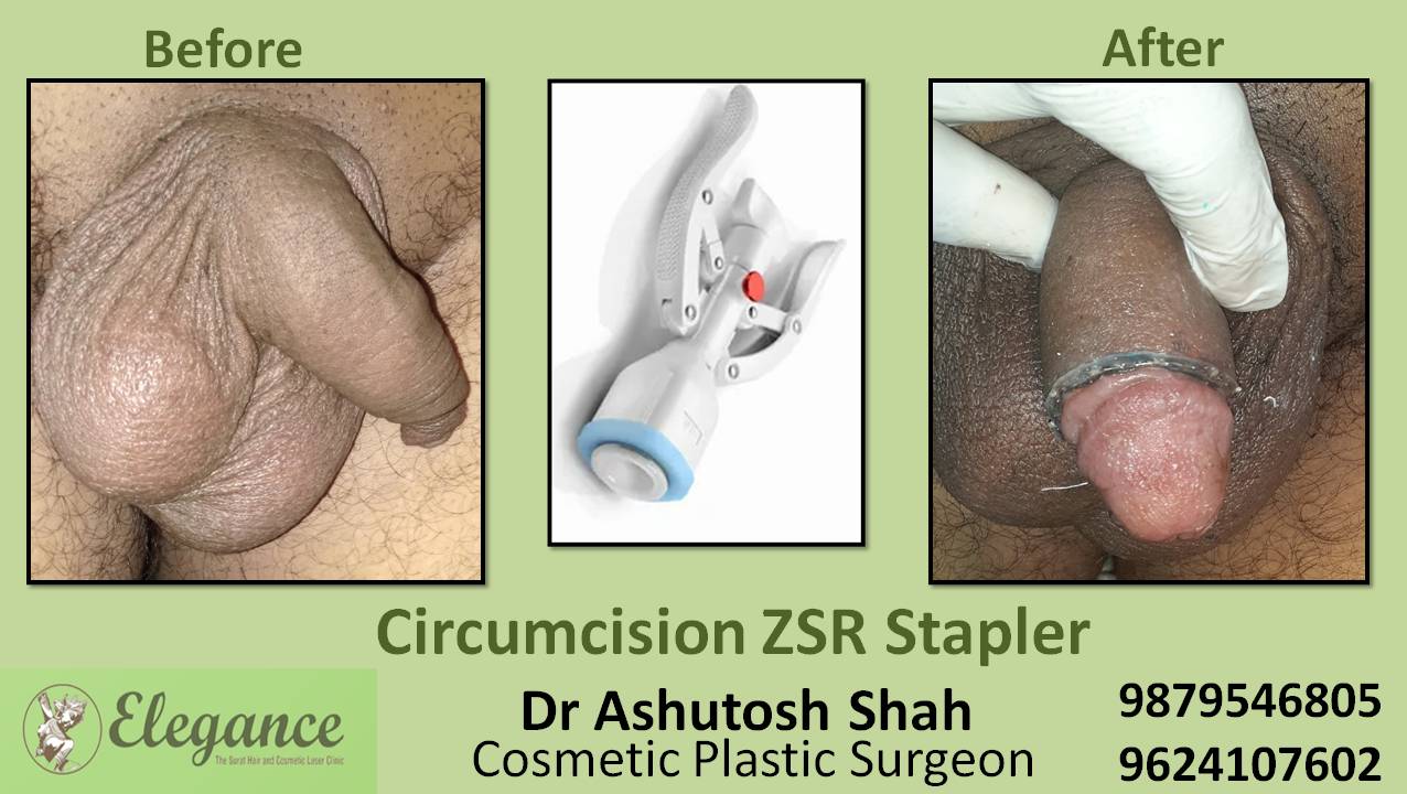 ZSR Circumcision Surgery, Valsad, Gujarat, India