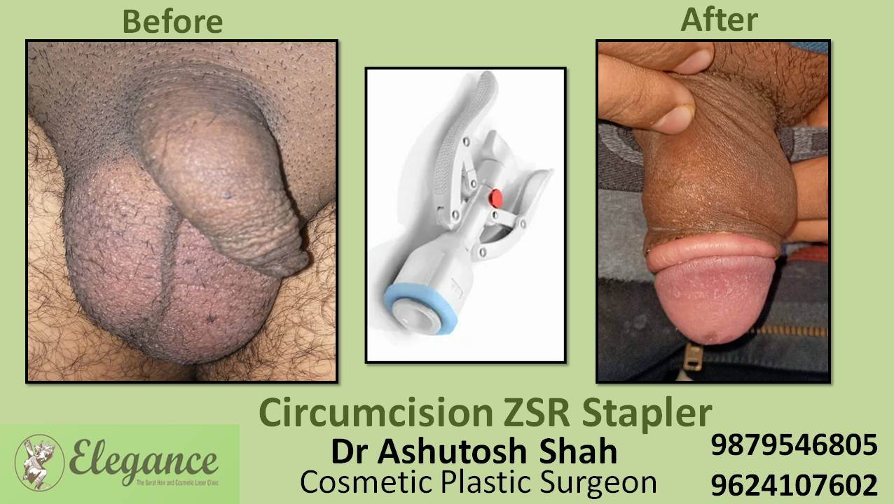 ZSR Circumcision Surgery, Vapi, Gujarat, India