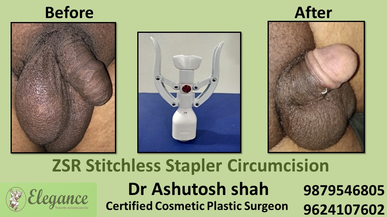 ZSR Stitchless Circumcision Surgery in Vapi