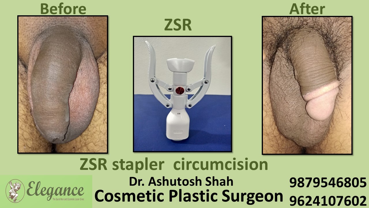ZSR Stitchless Circumcision Surgery in Gujarat